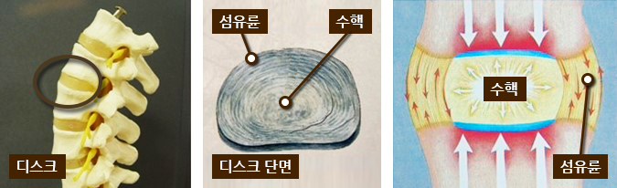 디스크 모형사진, 섬유륜/수핵/디스크단면, 수핵,섬유륜 이미지