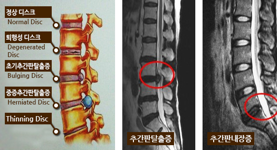 질환별 단계 이미지, 추간판탈출증, 추간판내장증